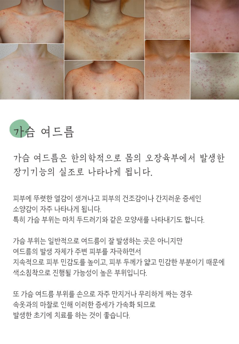 [창원점] 창원가슴여드름 가드름 긁어서 생긴 흔적, 없앨 수 있을까요? - 해율한의원
