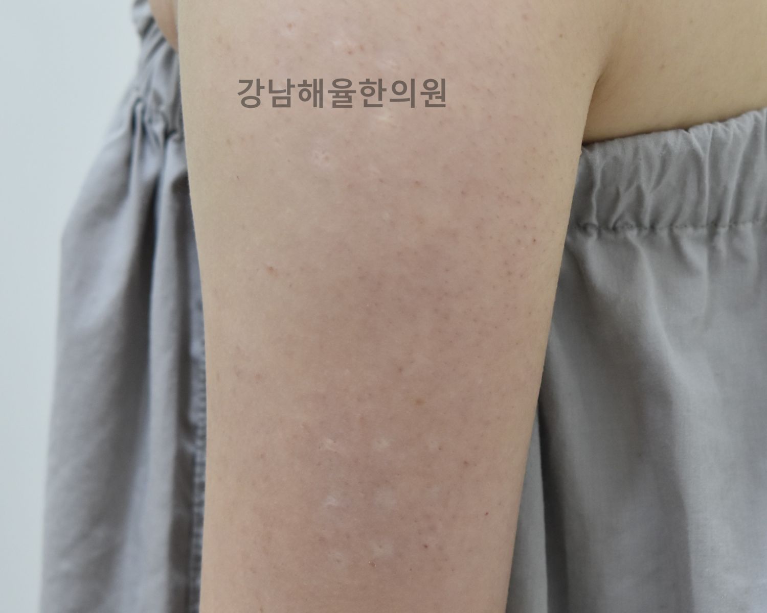 [강남점] 강남모공각화증 얼굴에도 생길 수 있나요? - 해율한의원