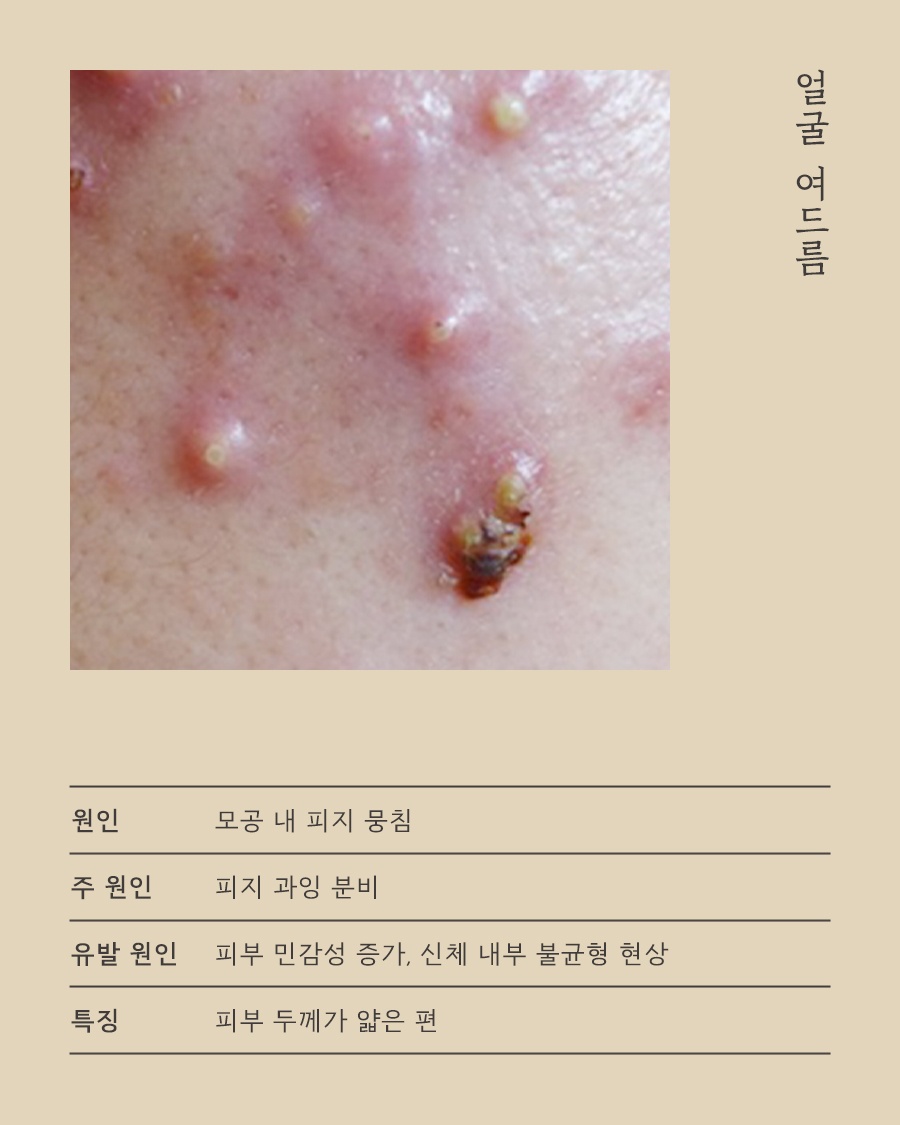[강남점] 강남가슴여드름 옷에 가려져도 방치하면 안 되는 이유 - 해율한의원