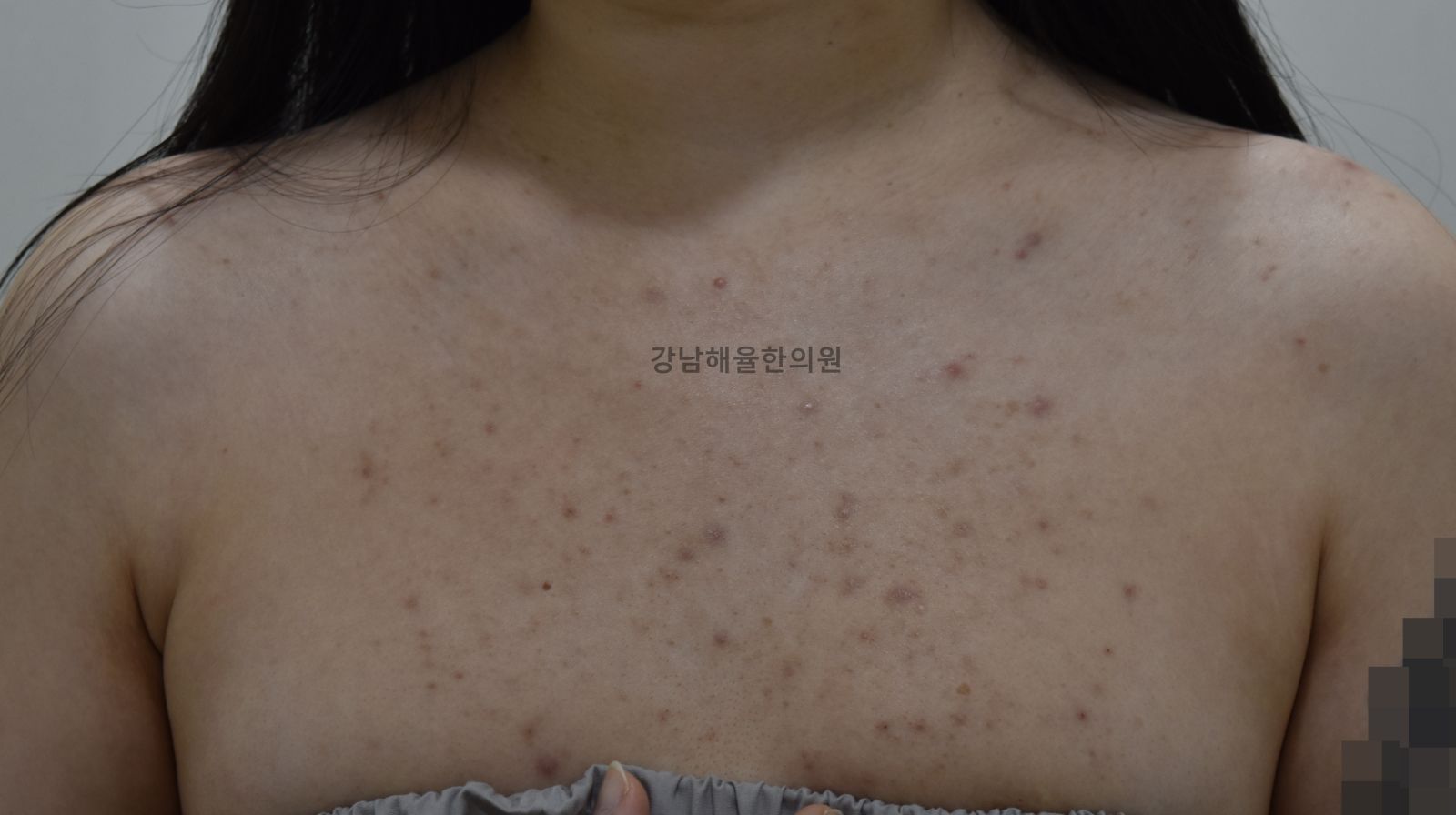 [강남점] 강남가슴여드름 옷에 가려져도 방치하면 안 되는 이유 - 해율한의원