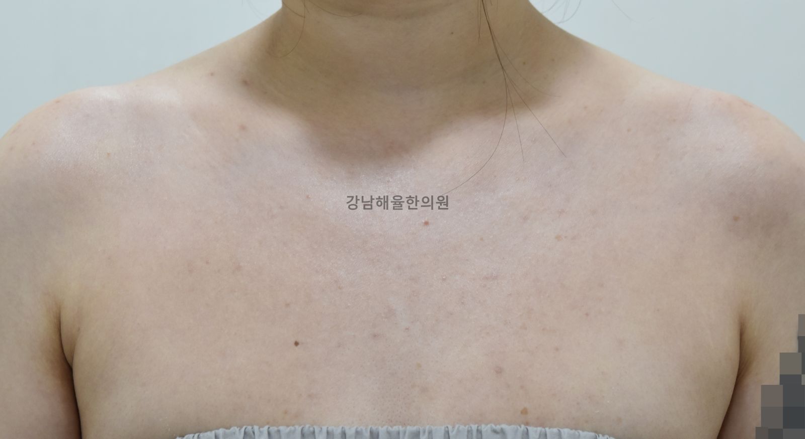 [강남점] 강남가슴여드름 옷에 가려져도 방치하면 안 되는 이유 - 해율한의원