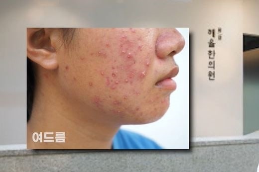 [강남점] 강남여드름흉터 자가 압출이 위험한 이유와 치료 방법은? - 해율한의원