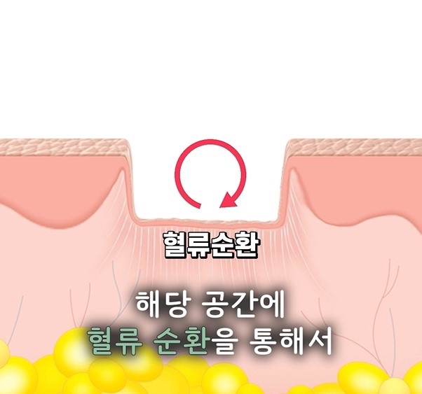 [강남점] 강남여드름흉터 자가 압출이 위험한 이유와 치료 방법은? - 해율한의원