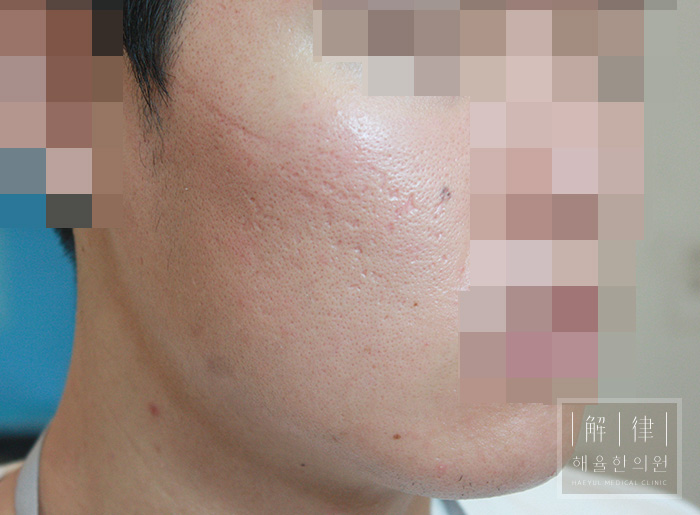 [광주점] 광주여드름피부과 한의원 치료에서 한약은 어떻게 활용되나요? - 해율한의원