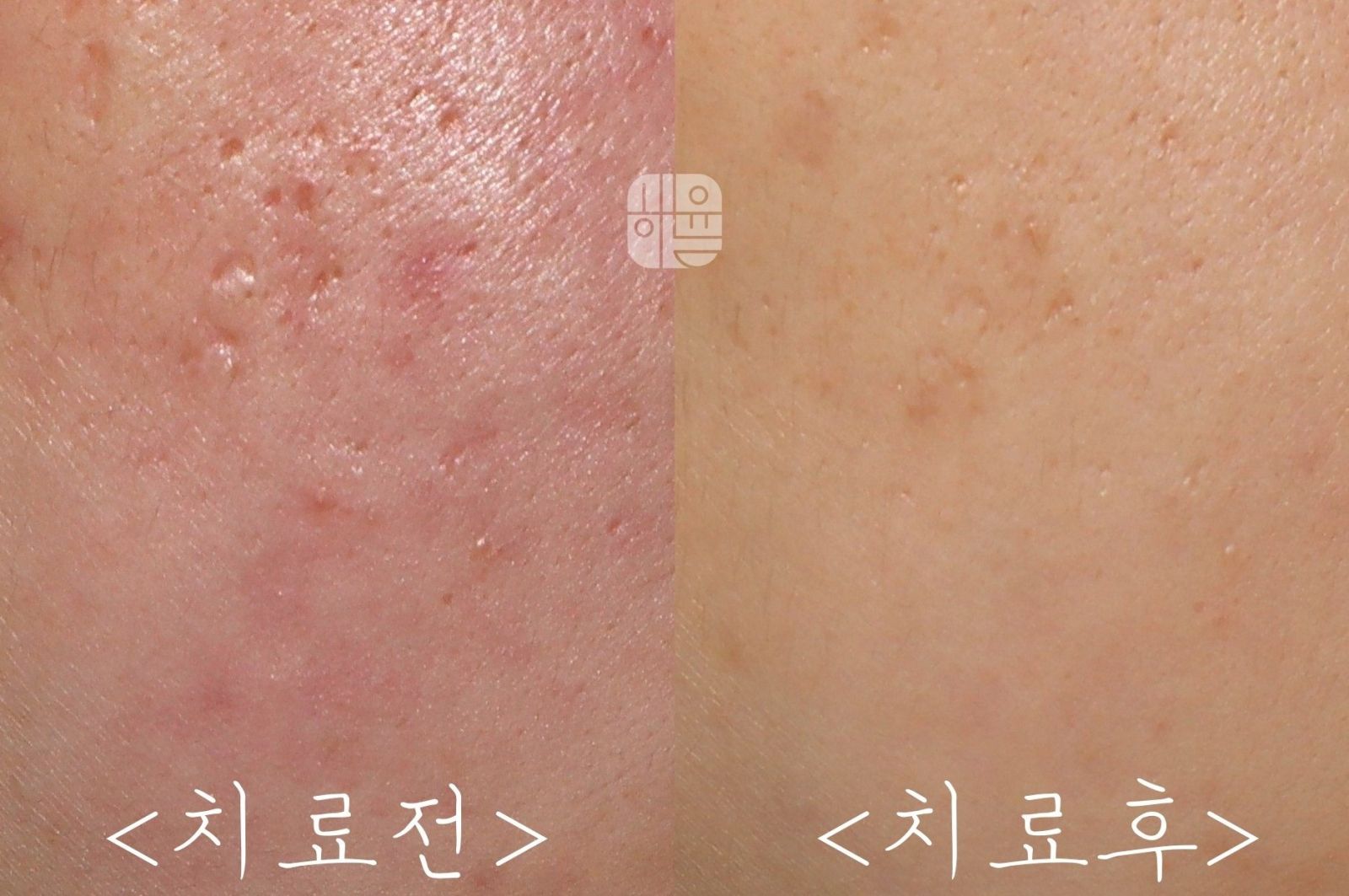 [광주점] 광주여드름치료 언제하는 게 가장 적절할까요? - 해율한의원