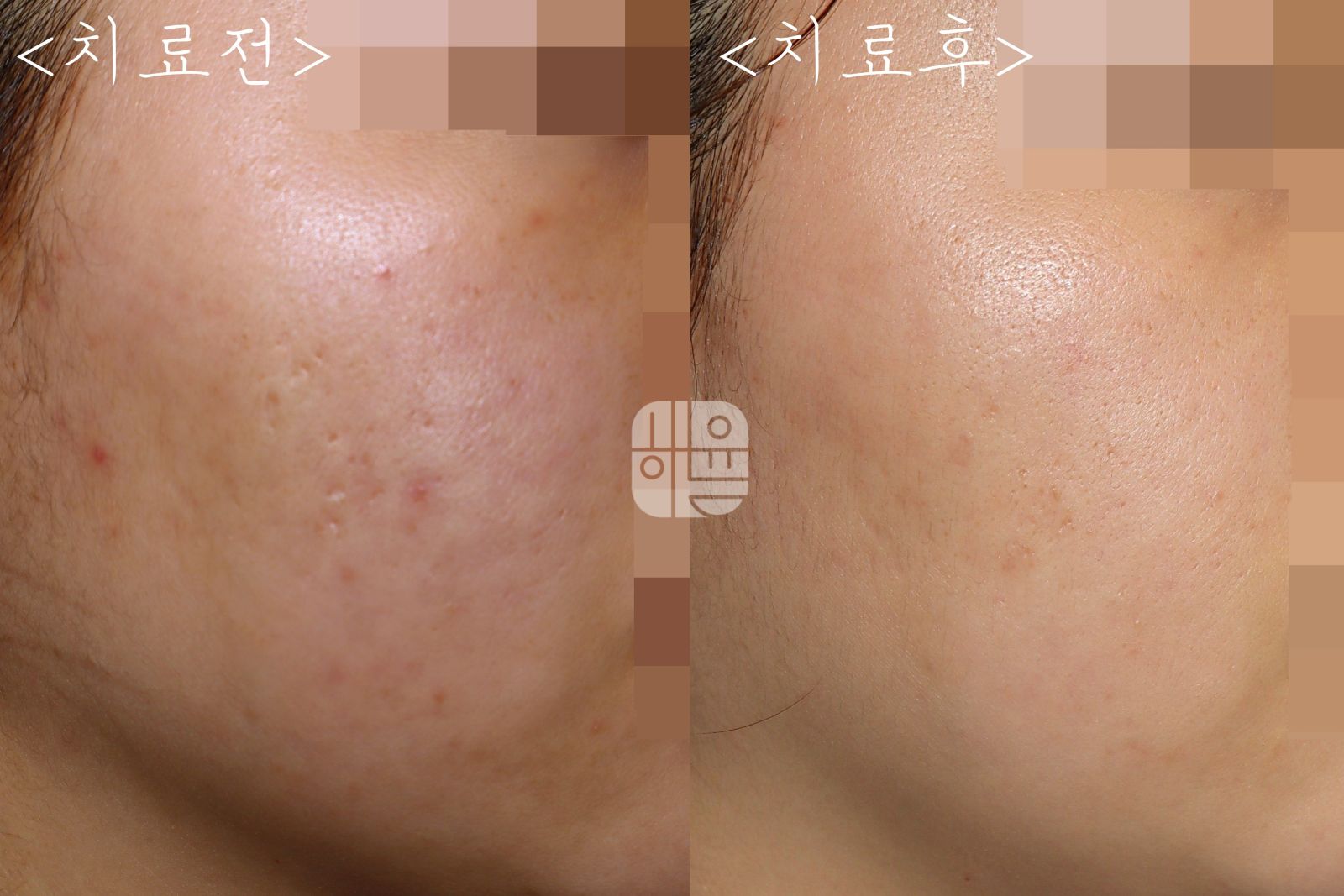 [광주점] 광주여드름치료 언제하는 게 가장 적절할까요? - 해율한의원
