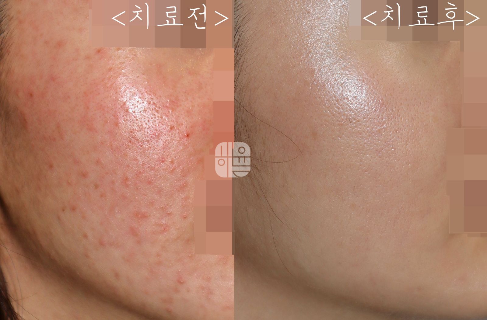 [광주점] 광주모낭염 여드름인 줄 알고 관리하고 있었다면, 어떻게 구분해야 할까요? - 해율한의원