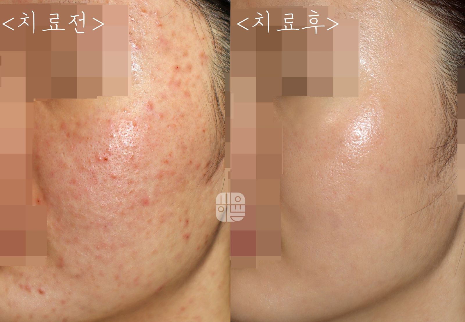 [광주점] 광주모낭염 여드름인 줄 알고 관리하고 있었다면, 어떻게 구분해야 할까요? - 해율한의원