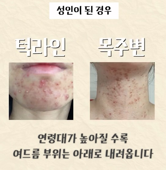 [광주점] 광주여드름한의원 성인과 청소년 여드름 무엇이 다를까요? - 해율한의원