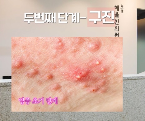 [광주점] 광주여드름한의원 성인과 청소년 여드름 무엇이 다를까요? - 해율한의원