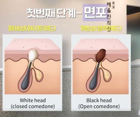 [광주점] 광주여드름한의원 성인과 청소년 여드름 무엇이 다를까요? - 해율한의원