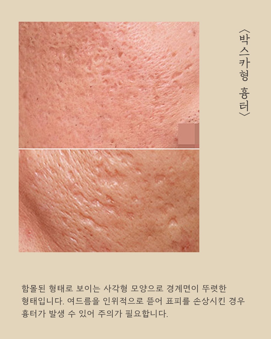 [노원점] 노원여드름흉터 치료 시기를 고민하고 있다면? - 해율한의원