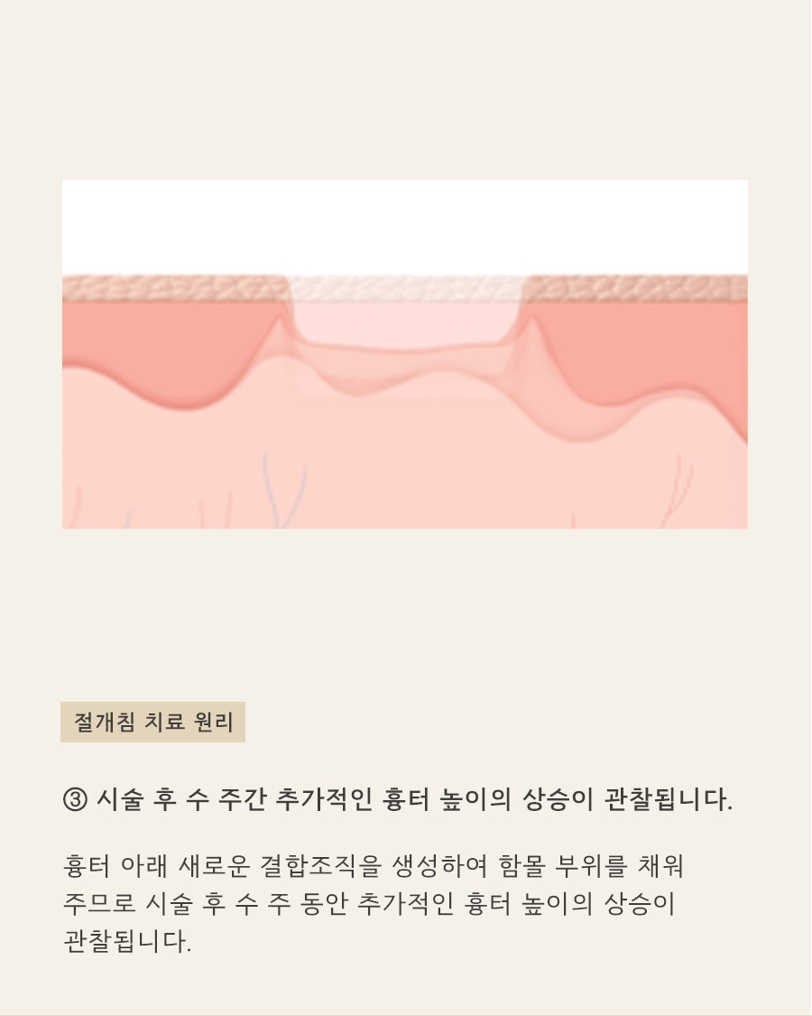 [노원점] 노원여드름흉터 치료 시기를 고민하고 있다면? - 해율한의원