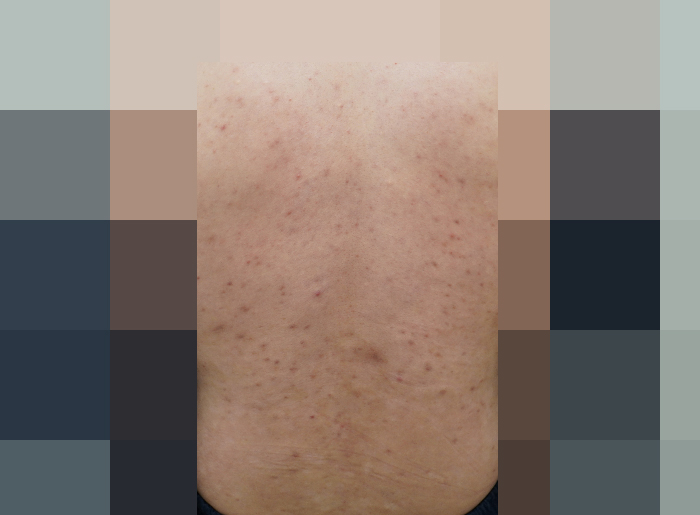 [안산점] 등여드름 등드름 색소침착 미세약초침 치료에 대해 안산 해율한의원이 설명드립니다 - 해율한의원
