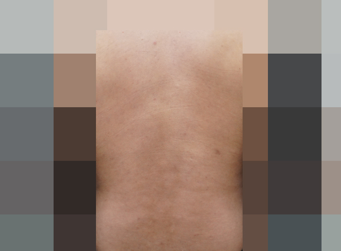 [안산점] 등여드름 등드름 색소침착 미세약초침 치료에 대해 안산 해율한의원이 설명드립니다 - 해율한의원