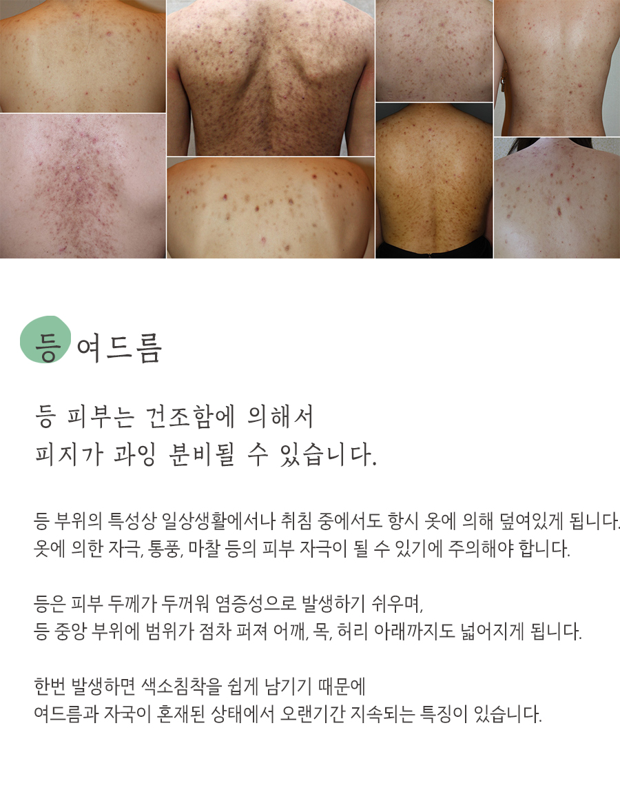 [창원점] 창원가슴여드름 가드름 긁어서 생긴 흔적, 없앨 수 있을까요? - 해율한의원