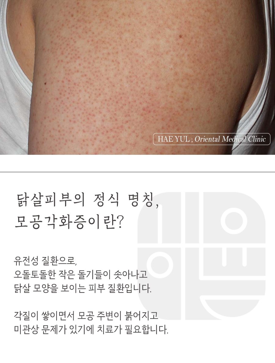 [창원점] 종아리모공각화증과 여드름은 어떻게 다른가요? 창원 해율한의원에서 설명드립니다 - 해율한의원