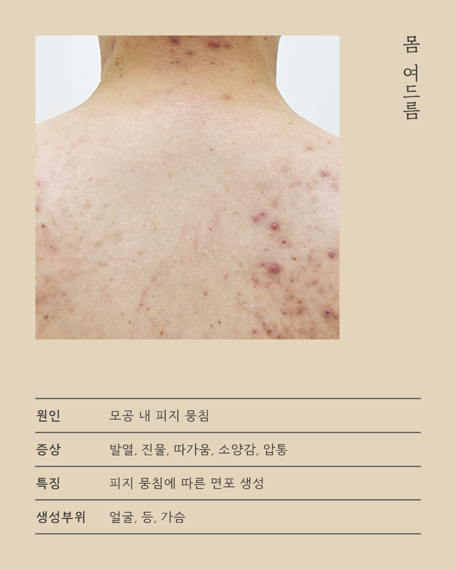[목동점] 목동모공각화증은 어떻게 치료하나요? - 해율한의원