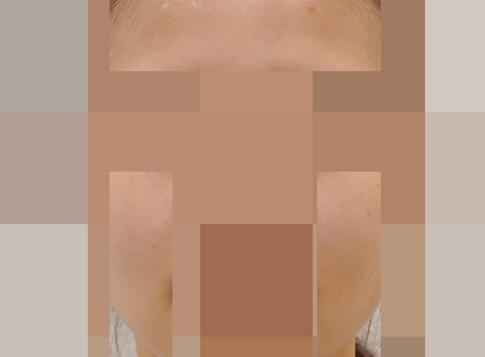 [안양점] 여드름피부과 안양해율한의원에서 재발 원인을 알려드립니다 - 해율한의원