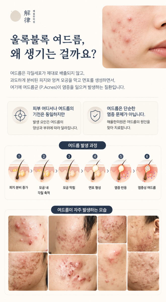 [목동점] 목동피부한의원 여드름, 지성 피부에 더 많이 올라올까요? - 해율한의원