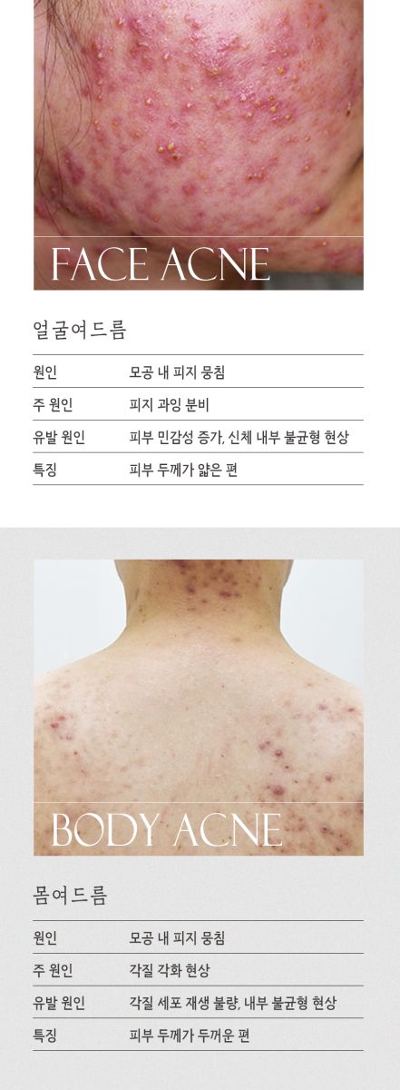 [창원점] 창원가슴여드름 가드름 긁어서 생긴 흔적, 없앨 수 있을까요? - 해율한의원