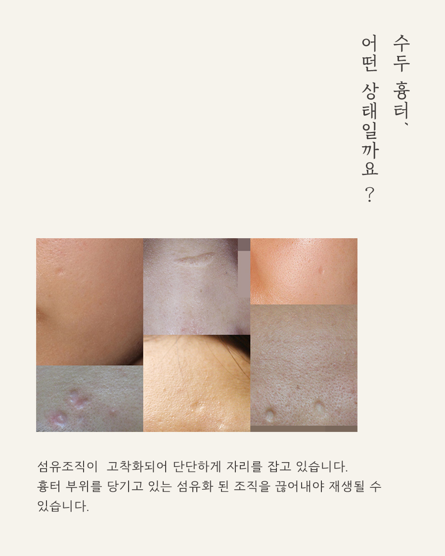 [천안점] 천안패인흉터 수두흉터 치료 방법에 대해 알려드려요 - 해율한의원