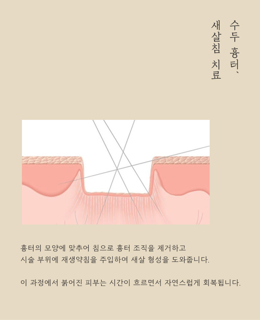 [대구점] 대구패인흉터 수두흉터 자연적으로 없어지지 않는 이유는? - 해율한의원