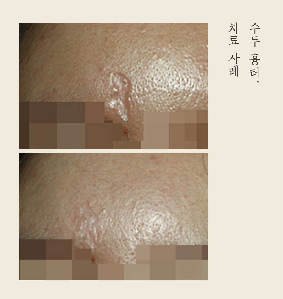[천안점] 천안패인흉터 수두흉터 치료 방법에 대해 알려드려요 - 해율한의원