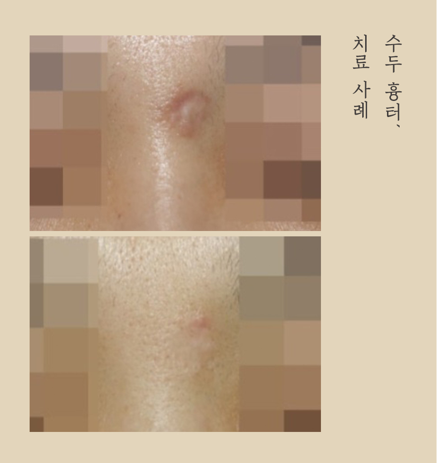 [대구점] 대구패인흉터 수두흉터 자연적으로 없어지지 않는 이유는? - 해율한의원
