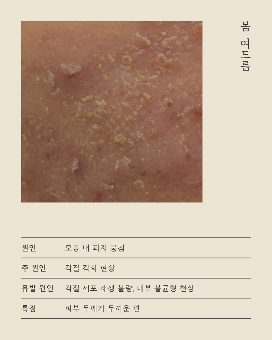 [수원점] 수원등여드름 어느 순간 넓게 번지고 있다면 원인 설명드립니다 - 해율한의원