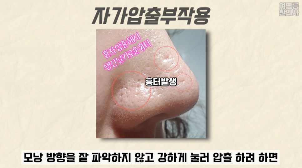 [수원점] 수원여드름흉터 압출 후 생겼다면? 새살침으로 치료하는 방법 - 해율한의원