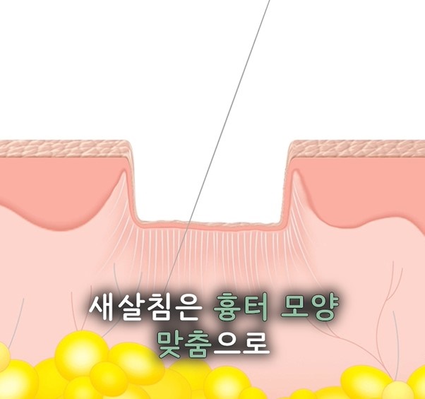 [수원점] 수원여드름흉터 압출 후 생겼다면? 새살침으로 치료하는 방법 - 해율한의원