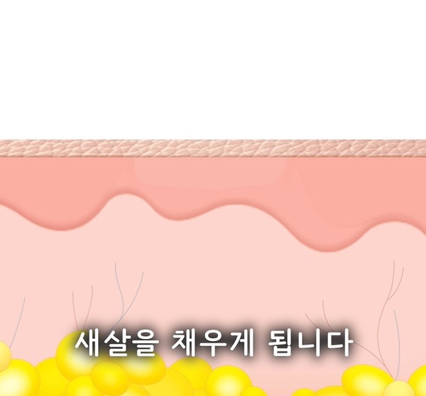 [수원점] 수원여드름흉터 압출 후 생겼다면? 새살침으로 치료하는 방법 - 해율한의원