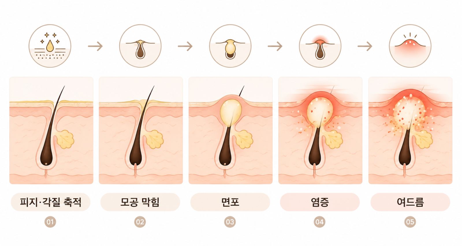 [안양점] 여드름피부과 안양해율한의원에서 재발 원인을 알려드립니다 - 해율한의원