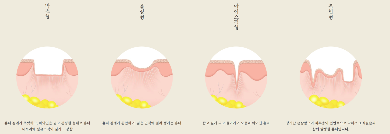 [수원점] 여드름 흉터, 전부 같은 게 아닌가요? - 해율한의원