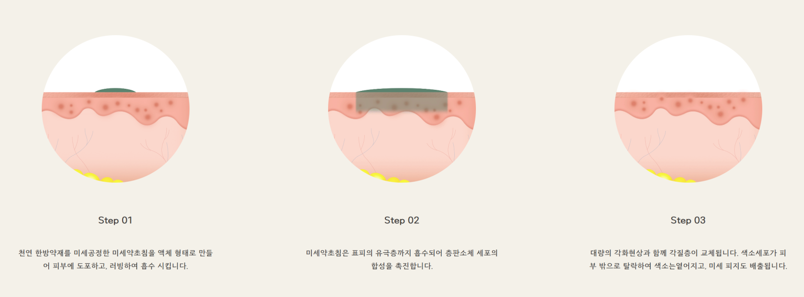 [수원점] 여드름 흉터, 전부 같은 게 아닌가요? - 해율한의원