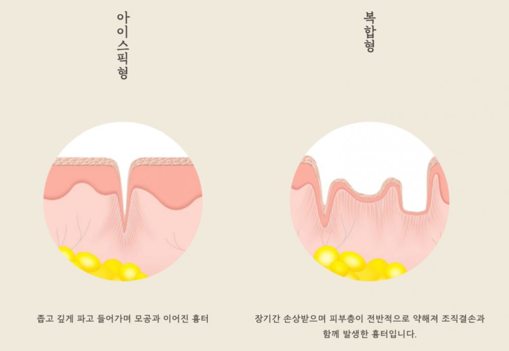 [수원점] 여드름흉터치료 무조건 빨리 시작할수록 좋은가요? - 해율한의원
