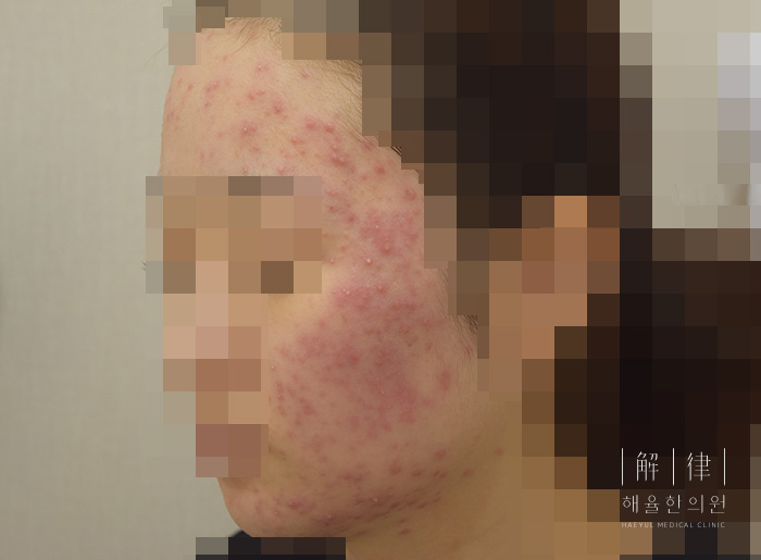 [안산점] 안산여드름한의원 압출 혼자서 하면 안되나요? - 해율한의원