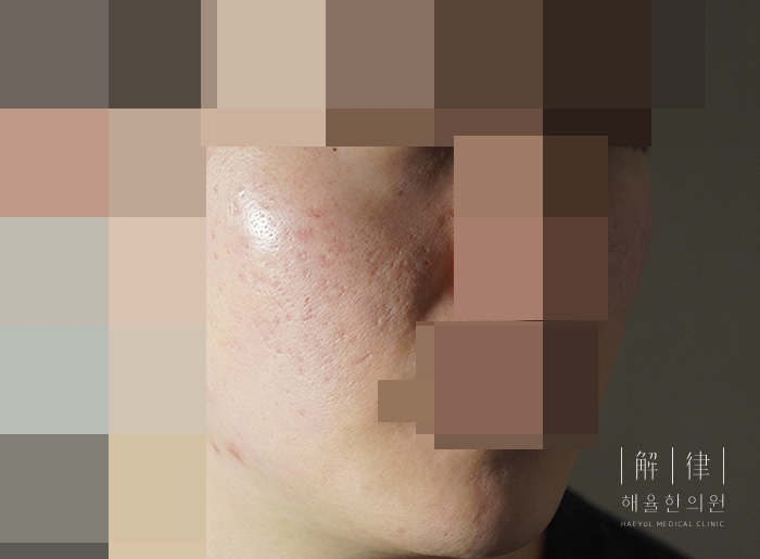 [안산점] 안산여드름흉터 오래된 흉터도 치료할 수 있나요? - 해율한의원