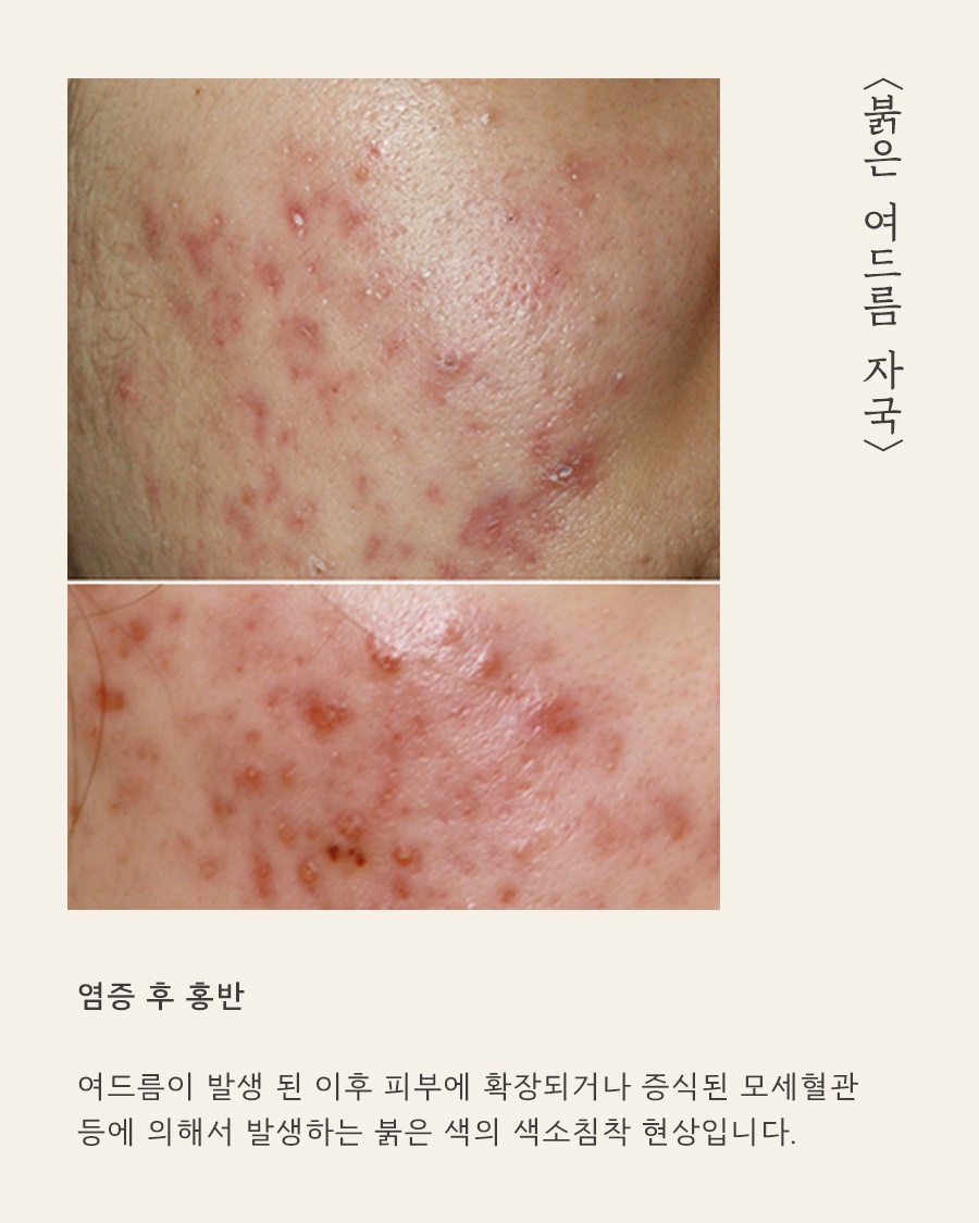 [안산점] 안산여드름자국 흉터랑 다른가요? 구분 및 예방법 - 해율한의원