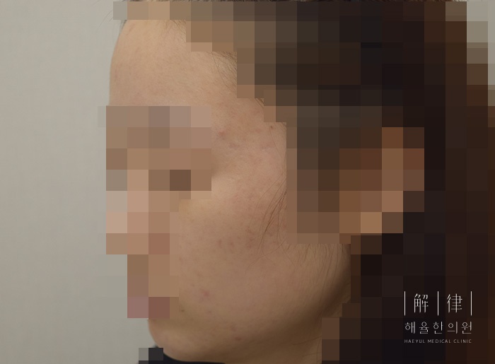 [안산점] 안산여드름피부과 한의원 갑자기 여드름이 늘었다면? - 해율한의원