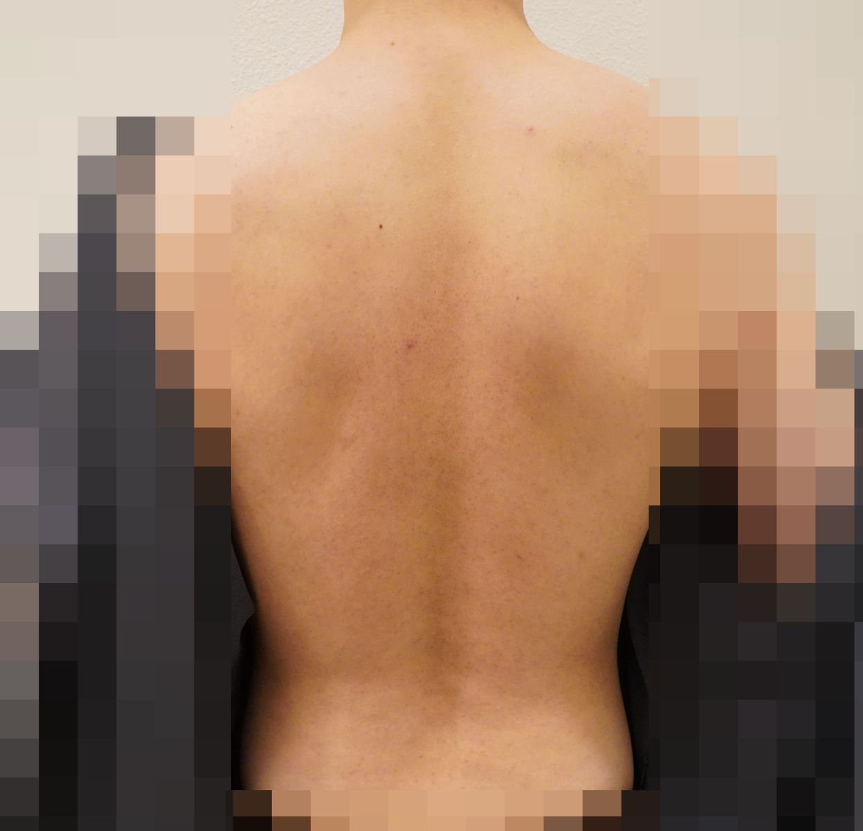 [안양점] 안양모공각화증 자꾸 만져지는 오돌토돌한 피부 고민, 원장님이 설명드립니다 - 해율한의원