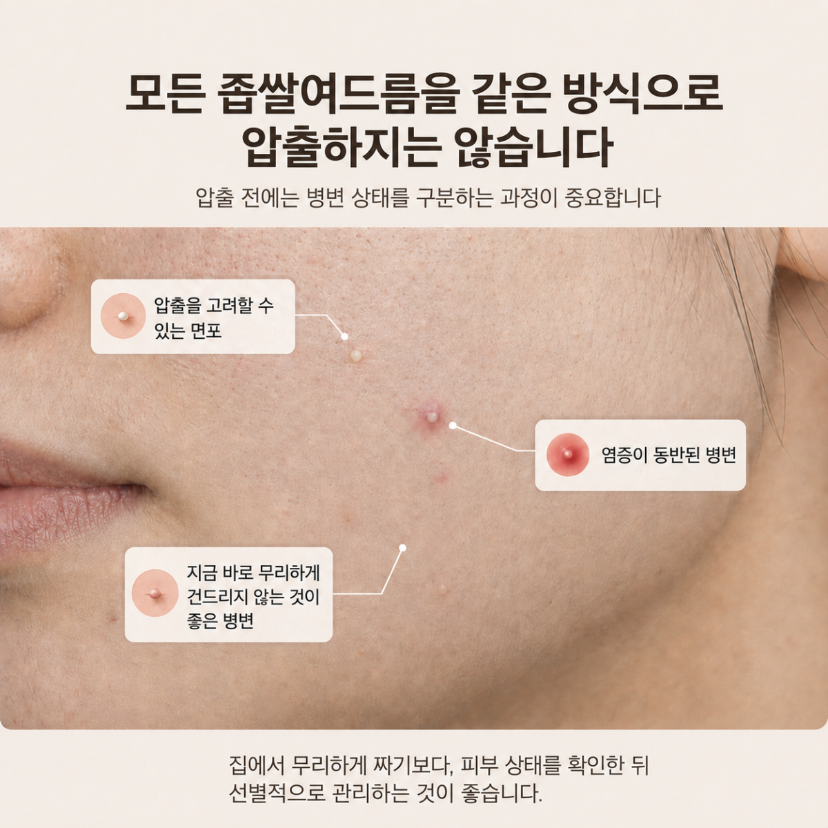 여드름 병변 상태에 따라 구분해서 압출을 진행해야 함을 보여주는 그림