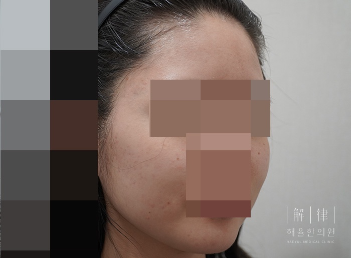 [안산점] 여드름 색소침착 피부에 남는 이유와 관리하는 방법 안산 해율한의원에서 알려드려요 - 해율한의원