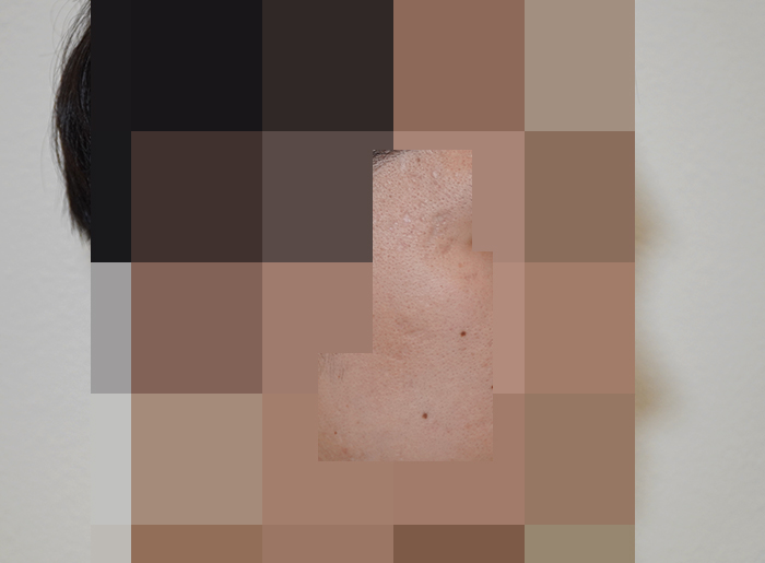 [안양점] 안양새살침 오래된 여드름 흉터도 치료 가능할까요? - 해율한의원