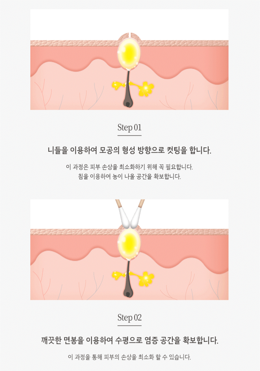 [대구점] 대구여드름한의원 반복되는 여드름, 어떻게 치료해야 할까? - 해율한의원
