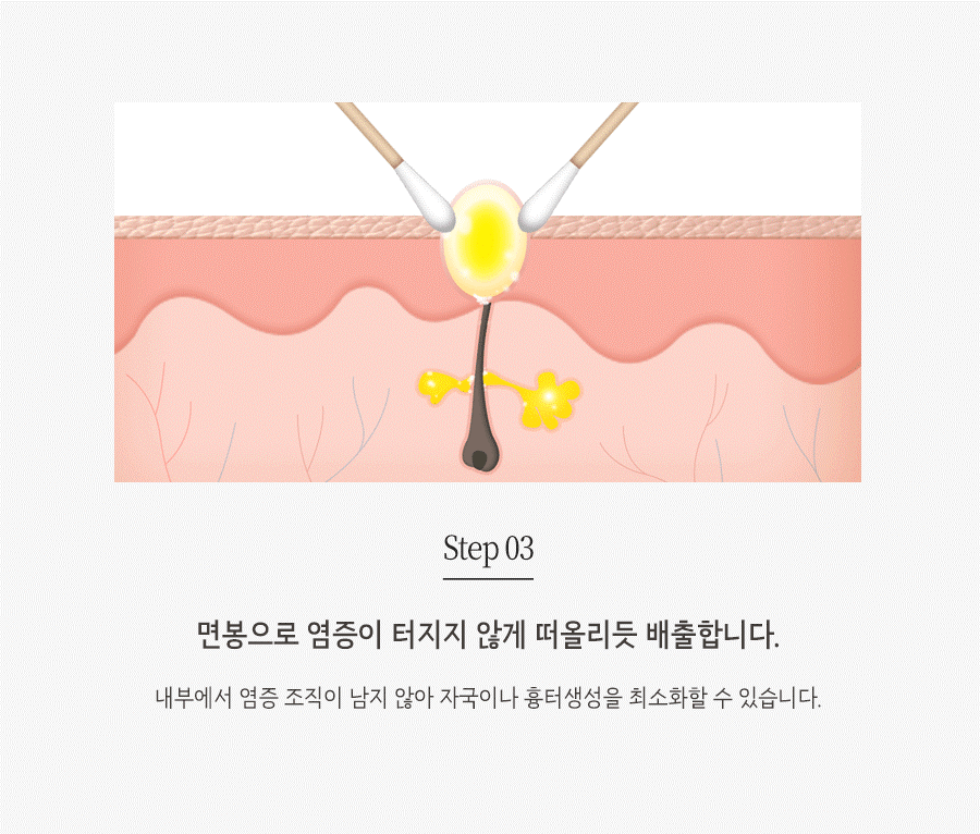 [대구점] 대구여드름한의원 반복되는 여드름, 어떻게 치료해야 할까? - 해율한의원