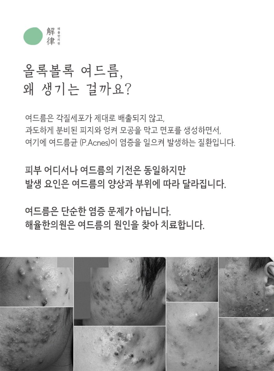 [대구점] 대구여드름한의원 반복되는 여드름, 어떻게 치료해야 할까? - 해율한의원