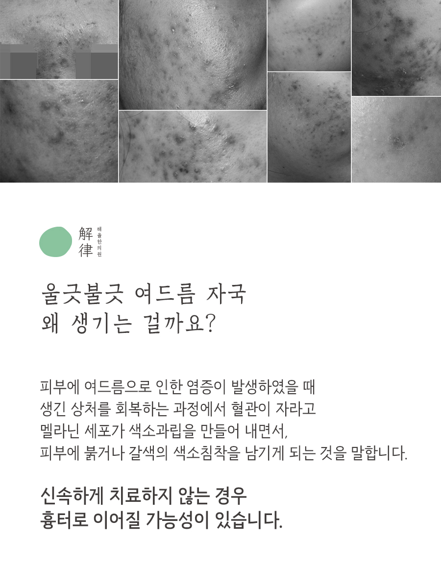 [안산점] 안산여드름자국 오래 남는 이유와 관리법, 원장님이 설명드립니다 - 해율한의원