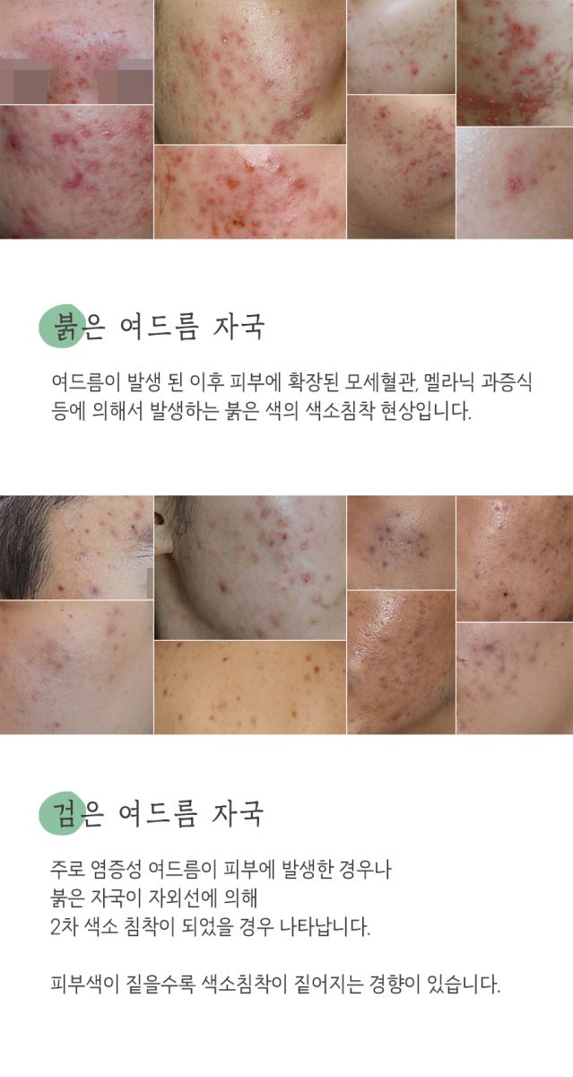 [목동점] 여드름자국 모공 축소 치료는 보통 얼마나 걸리나요? 목동 해율한의원에서 설명드립니다 - 해율한의원